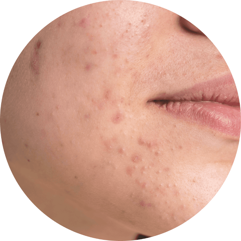 Acne