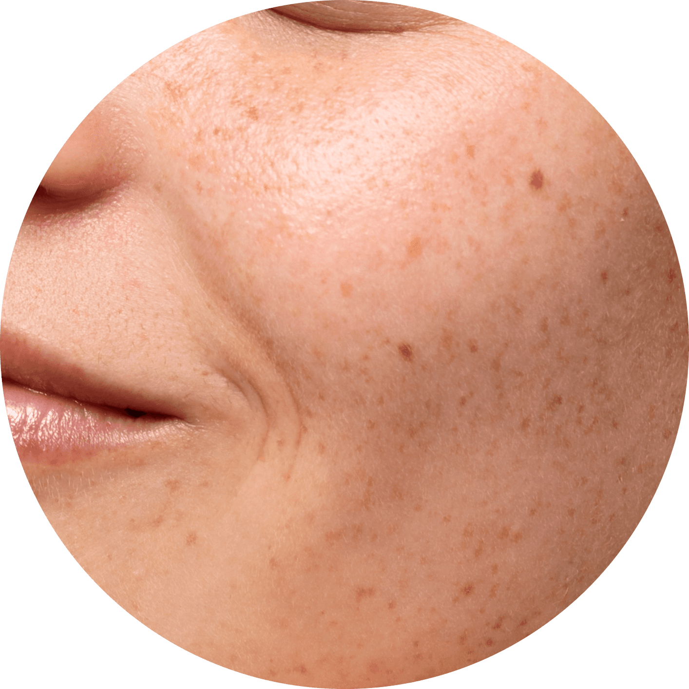 Pigmentation